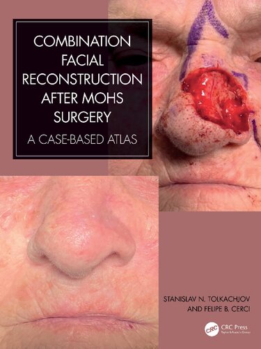 Combination Facial Reconstruction after Mohs Surgery: A Case Based Atlas [Team-IRA]