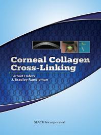 Corneal Collagen Cross Linking