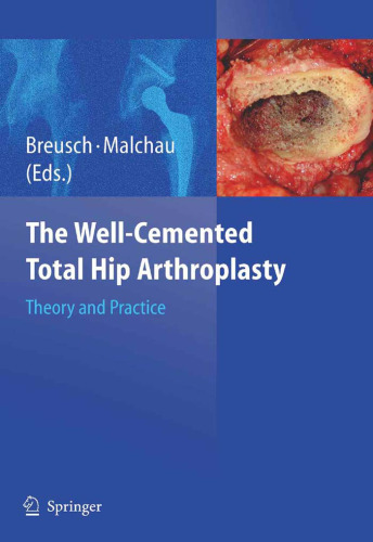 The Well-Cemented Total Hip Arthroplasty: Theory and Practice