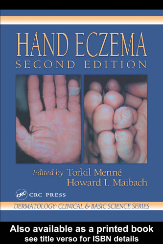 Hand Eczema, Second Edition (Dermatology - Clinical and Basic Science)