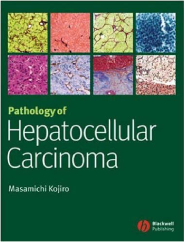 Pathology of Hepatocellular Carcinoma