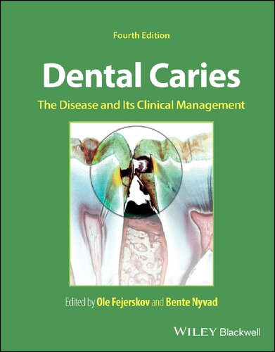 Dental Caries: The Disease and its Clinical Management