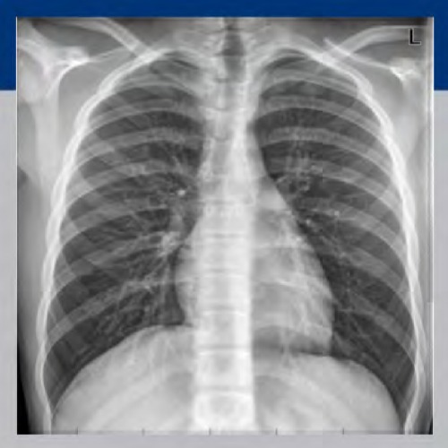 Atlas of Chest & Tb X- Rays