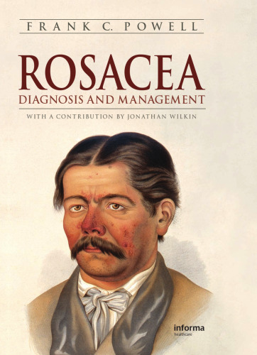 Rosacea: Diagnosis and Management