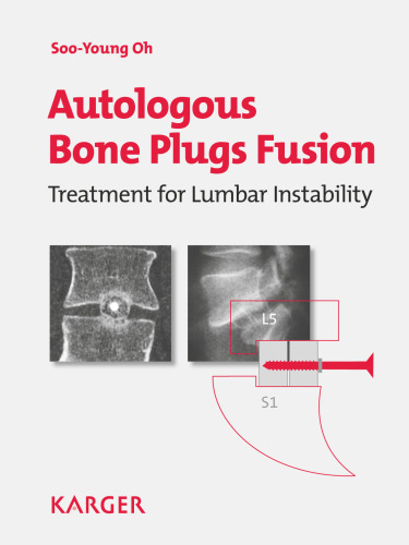 Autologous Bone Plugs Fusion: Treatment for Lumbar Instability: 3E Criteria  Technical Operative Notes  The Functioning of the Oh's Screw