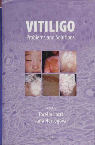 Vitiligo: Problems and Solutions