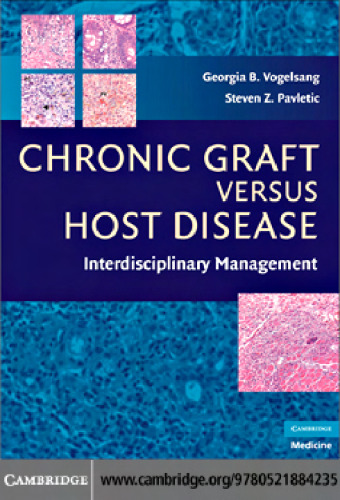 Chronic Graft Versus Host Disease: Interdisciplinary Management