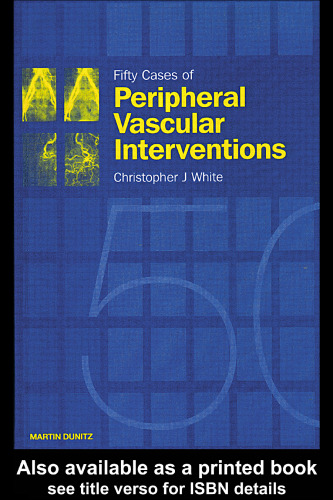 Fifty Cases of Peripheral Vascular Interventions