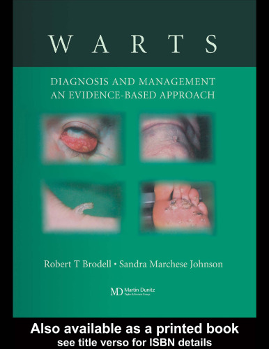 Warts: Diagnosis and Management: An Evidence Based Approach