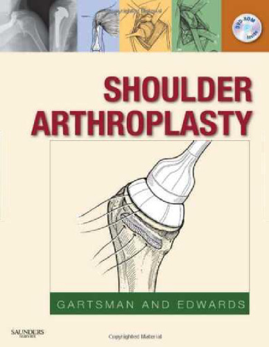 Shoulder Arthroplasty