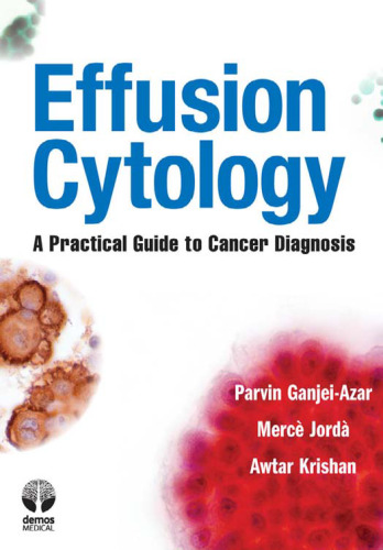 Effusion Cytology: A Practical Guide to Cancer Diagnosis  