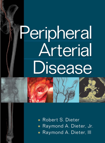 Peripheral Arterial Disease  