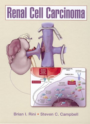 Renal Cell Carcinoma  