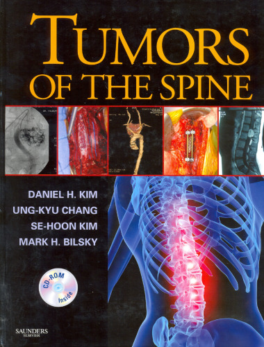 Tumors of the Spine