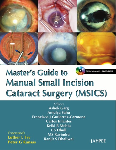 Master's Guide to Manual Small Incision Cataract Surgery