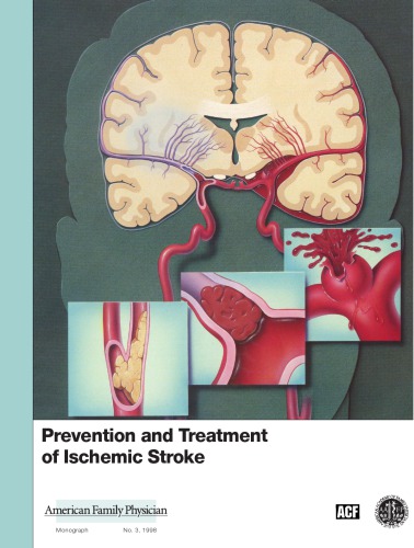 Prevention And Treatment Of Ischemic Stroke