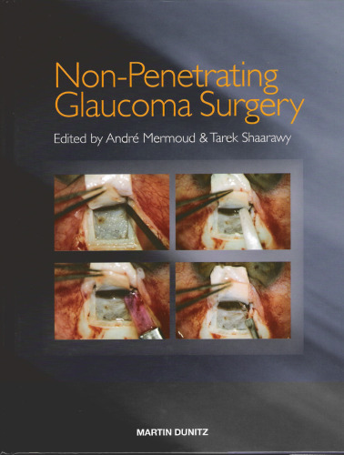 Non-penetrating glaucoma surgery